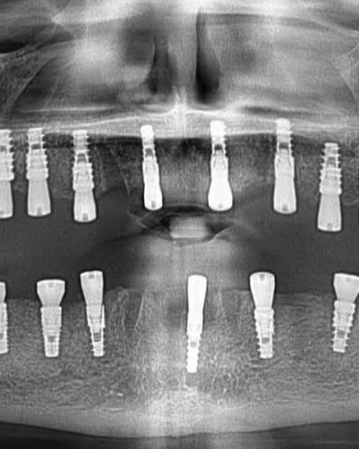Full-arch dental implant radiograph planned at mySmile Tirana