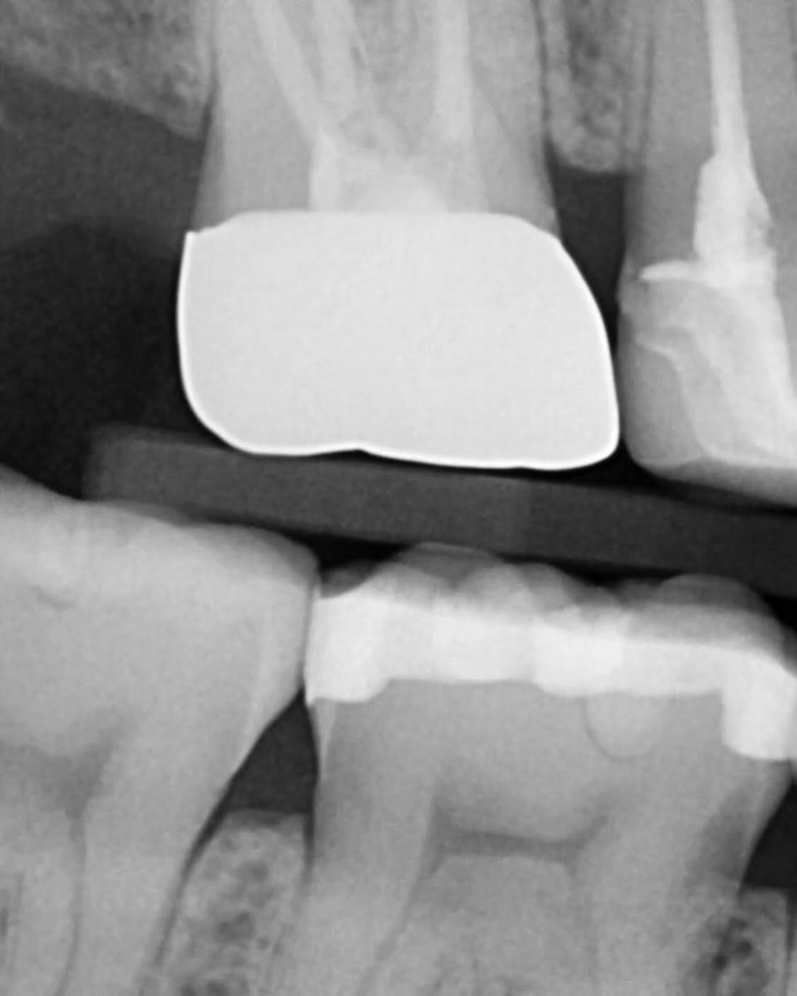 Close dental radiograph showing a ceramic crown and restorations at mySmile Tirana